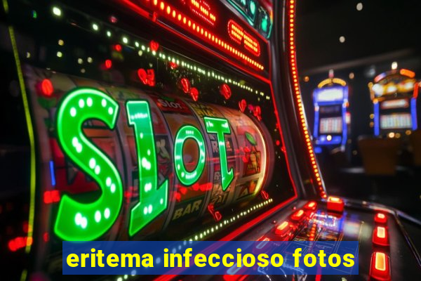 eritema infeccioso fotos